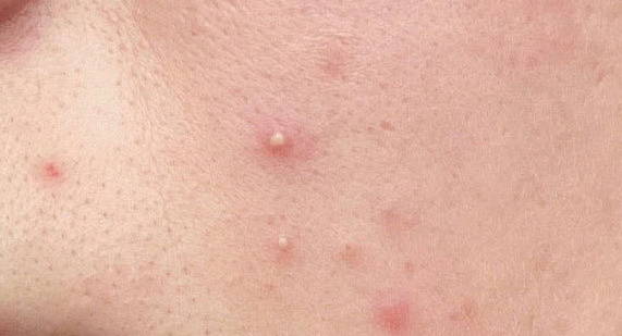 近年来祛痘类功效护肤品发展如何?